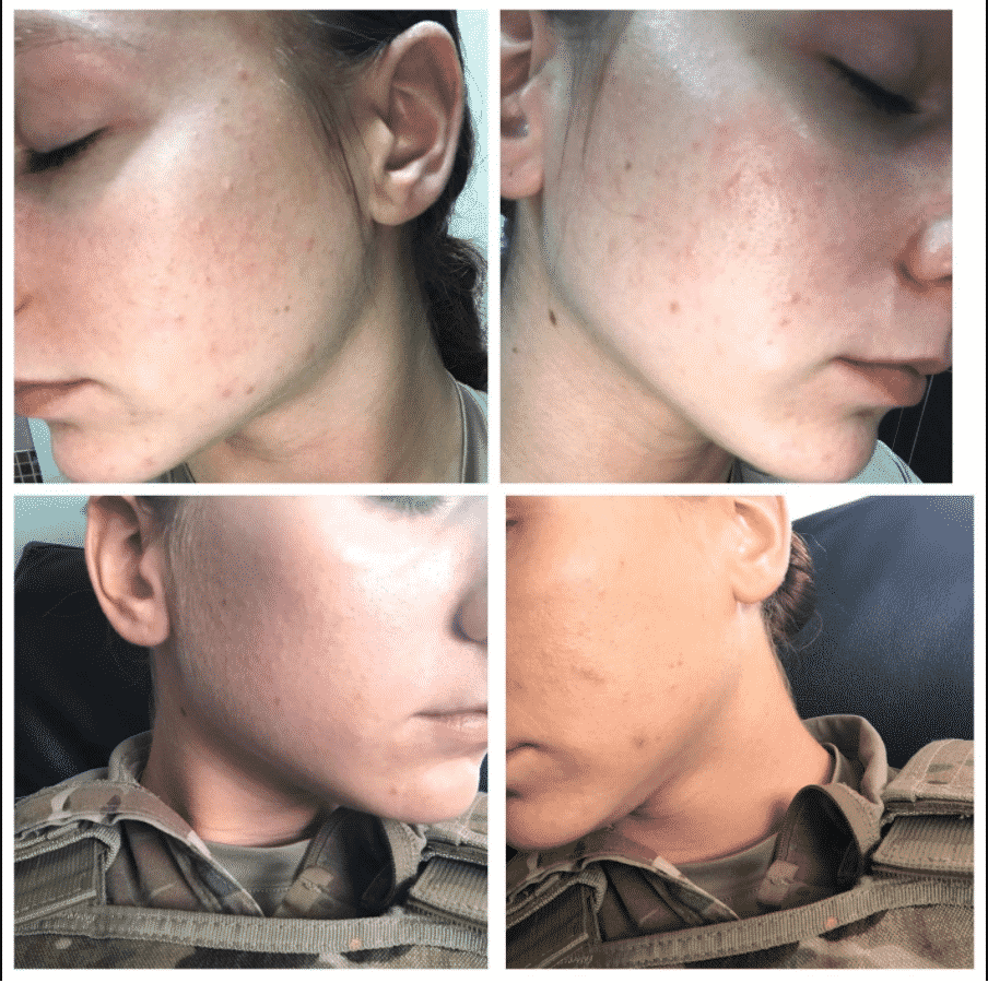 humane acne wash before and after