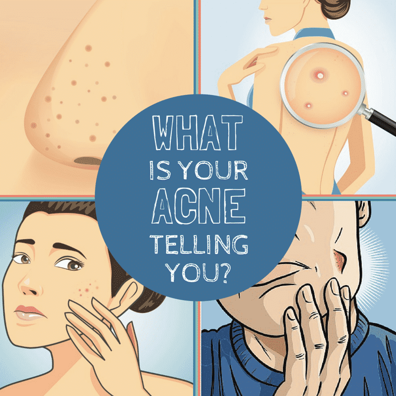 acne and health
